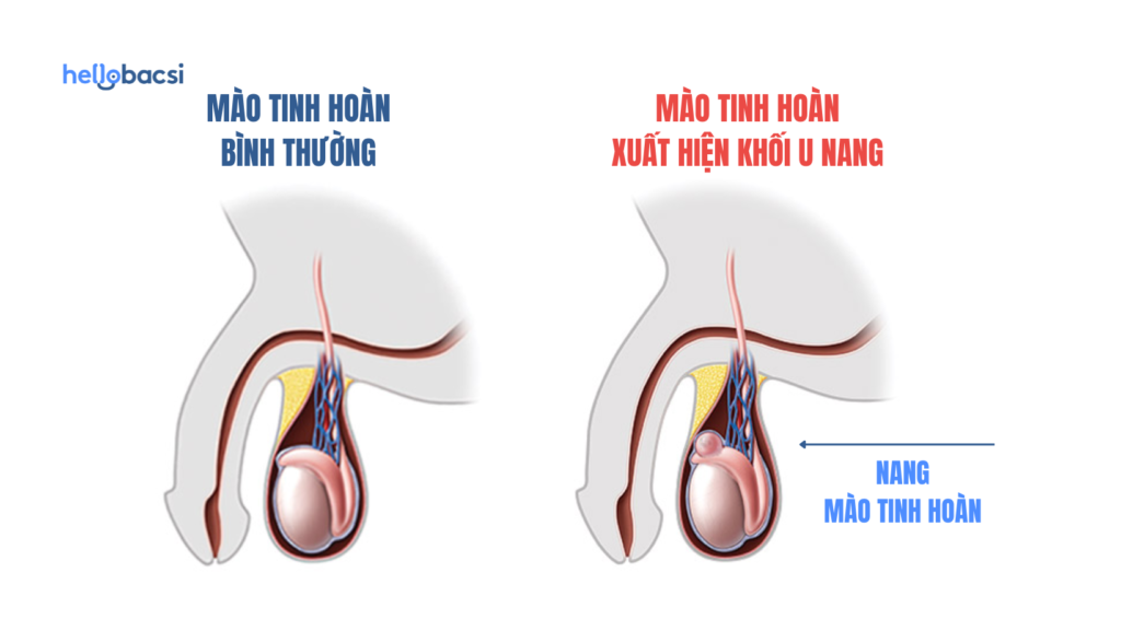 Đau Tinh Hoàn Bên Trái Là Bệnh Gì?